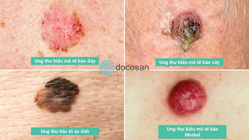 Phân biệt các loại ung thư trên da